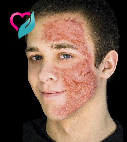 burn scars on face real