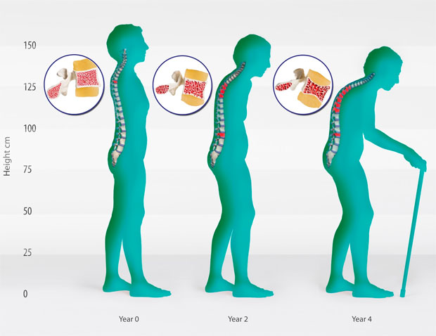 Osteoporosis