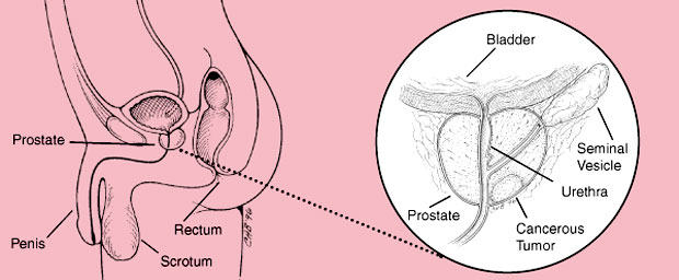 prostate cancer