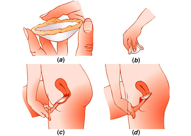 vagainal diaphram 