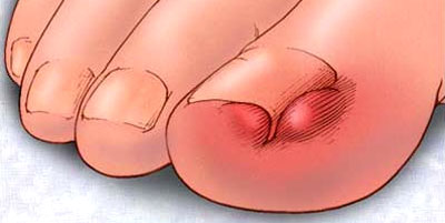 Ingrown toenails 