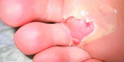 blister in foot