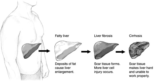 liver cirrhosis 