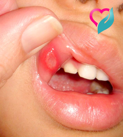 mouth ulcer