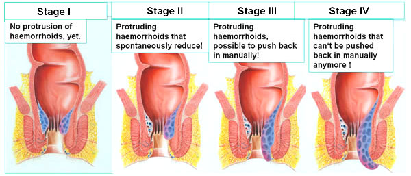 stages of piles