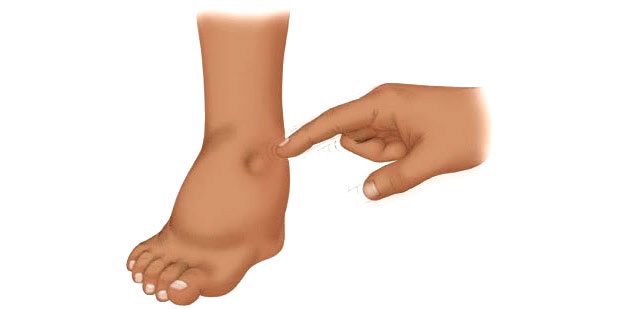 swollen foot