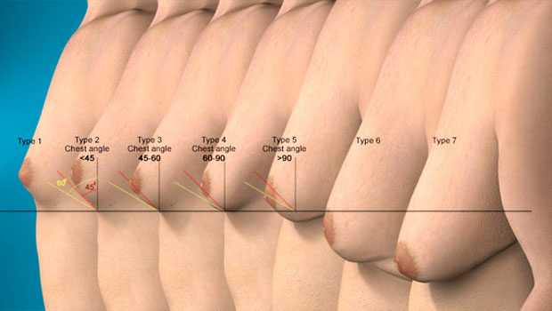 types of Gynecomastia