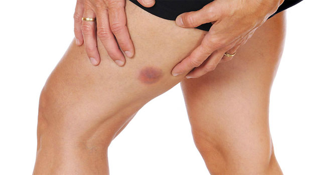 inner thigh rash