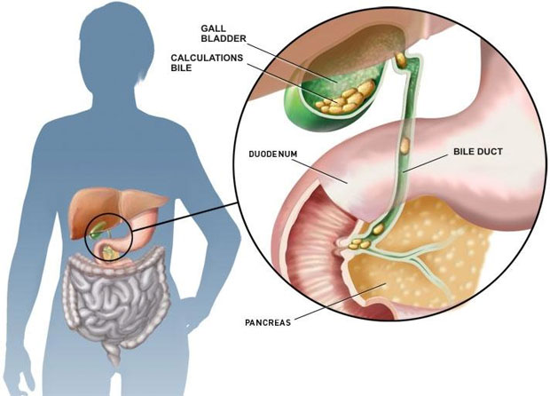 gall bladder stones