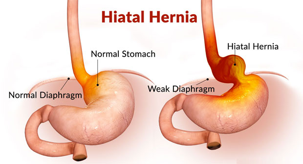 hiatal-hernia