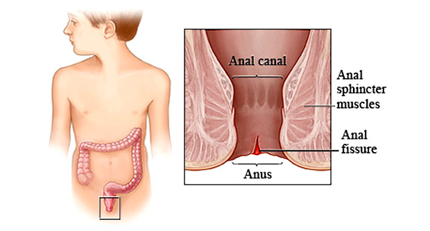 Anal Fissures