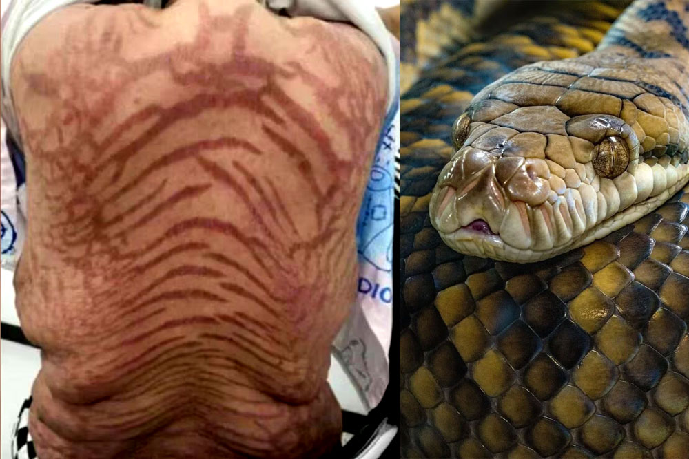 സ്റ്റിറോയിഡ് ക്രീം പാർശ്വഫലം